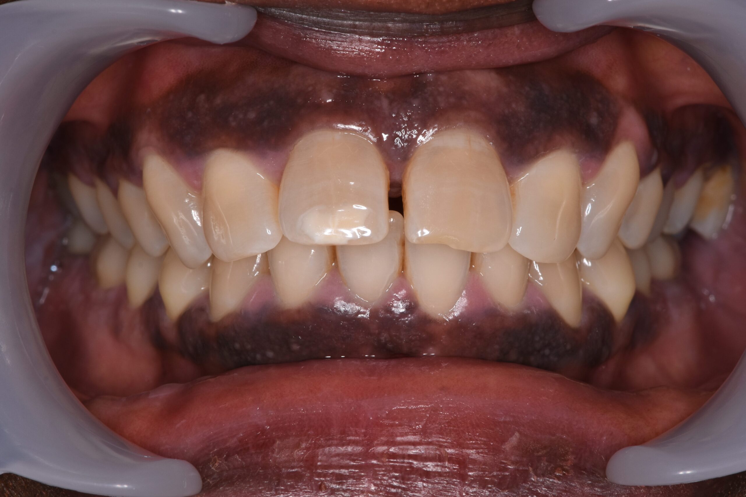 JF before2-min JF before2-min