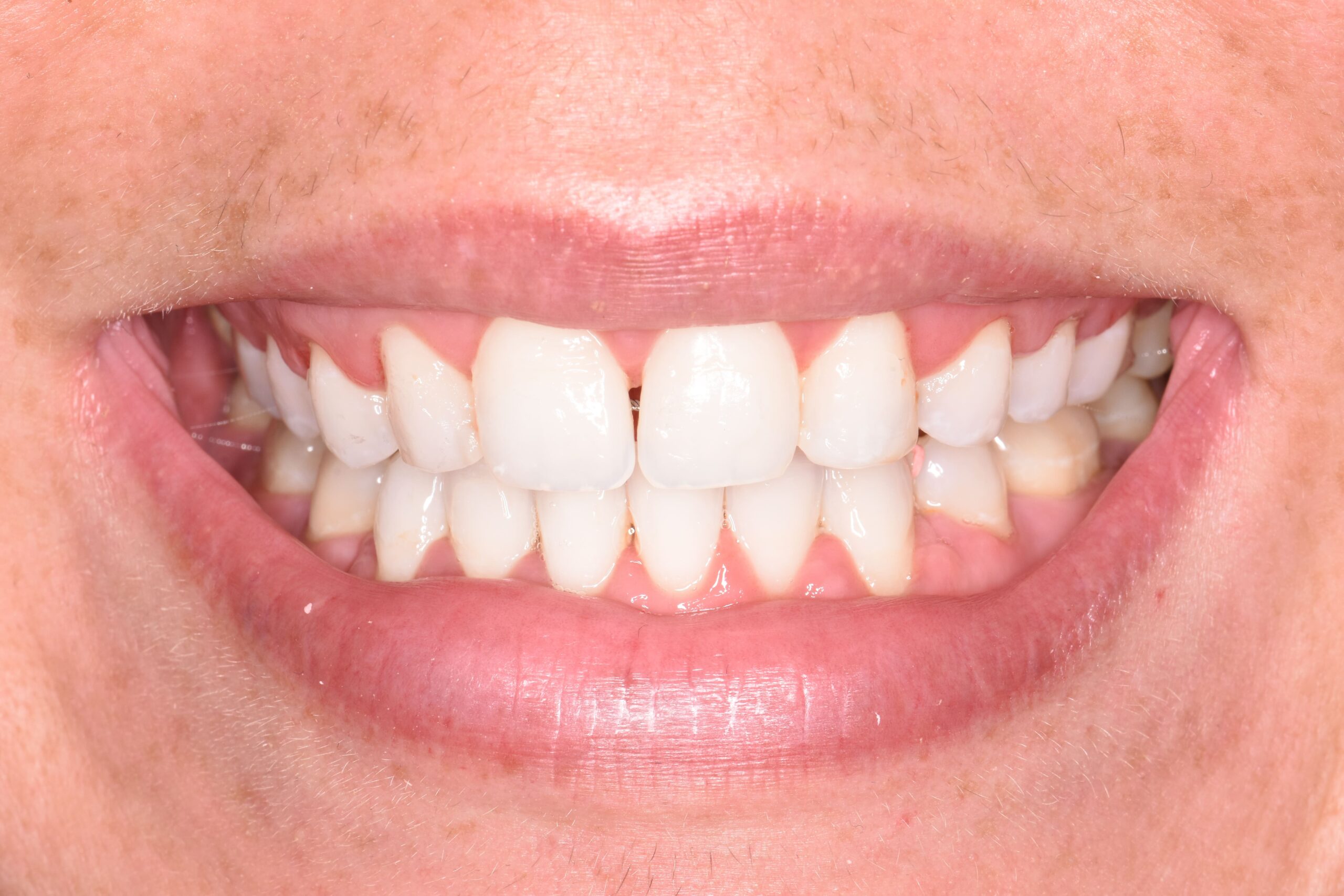 SM before-min SM before-min